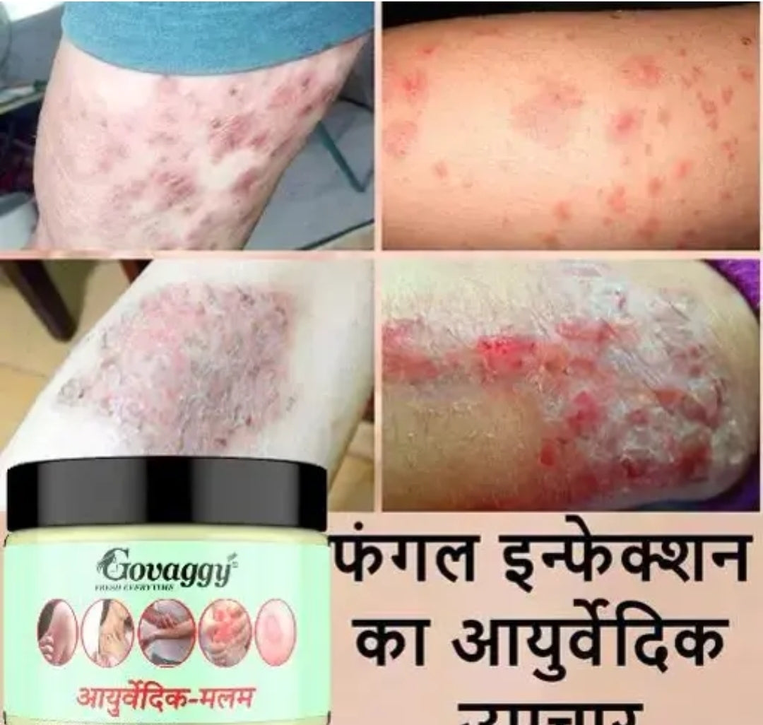 Ayurvedic cure fungul infection DM719